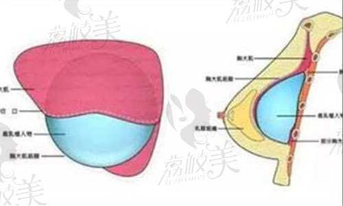 雙平面隆胸