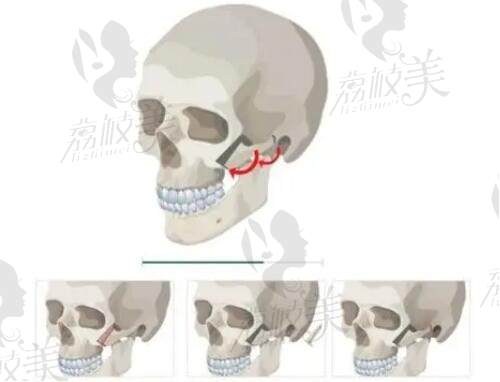 崔宇景颧骨手术术式