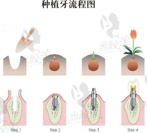 全口种植牙中