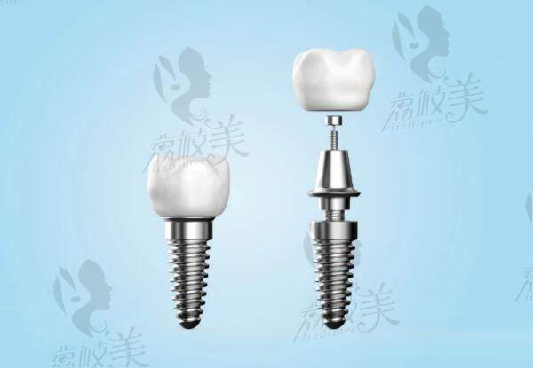 种植牙技术治疗牙齿缺失