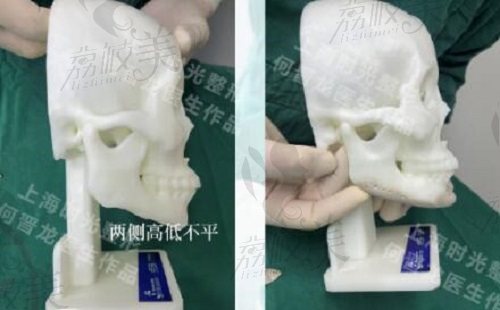 3D打印peek材料下颌角缺损修复重建手术