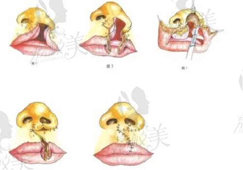 北京煤醫(yī)王馳唇裂修復(fù)
