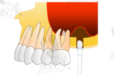 上颌窦提升术的特点和优势1