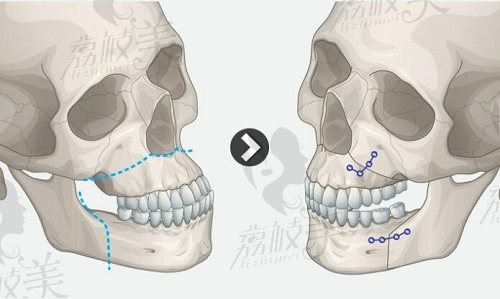 韩国双鄂手术