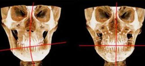 韩国双鄂手术CT对比