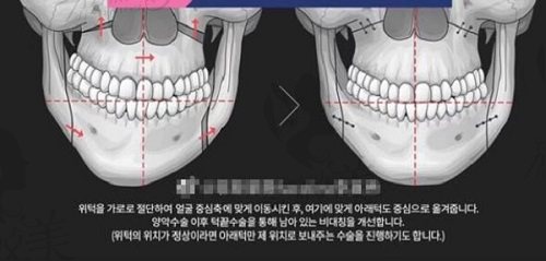 韩国菲斯莱茵（faceline）整形医院李真秀双鄂手术