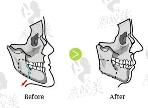 正颌手术原理过程