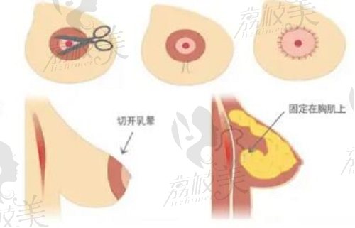 乳房下垂悬吊提升双环法手术方式