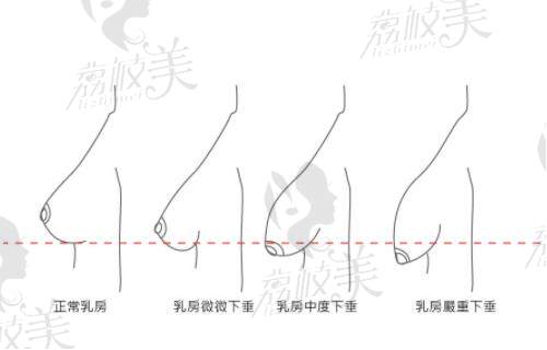 胸部下垂韌帶懸吊術(shù)哪里做得好?集合國內(nèi)乳房下垂矯正好的醫(yī)院醫(yī)生