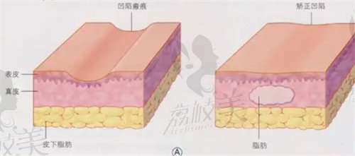 乔爱军脂肪填充价格多少？