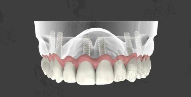 All-on-6种植牙技术