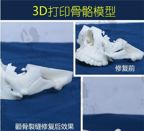 3D打印骨骼模型