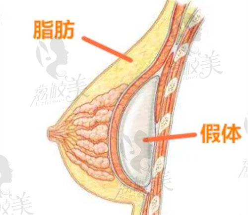 复合隆胸示意图