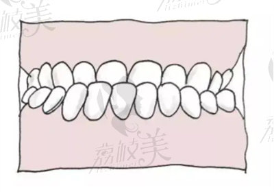 金属托槽矫正的适用范围