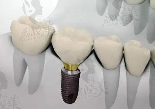 种植牙示意图