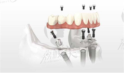 汪龍河醫(yī)生在all-on-4種植方面的技術(shù)優(yōu)勢4