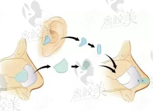 鼻整形手术示意图