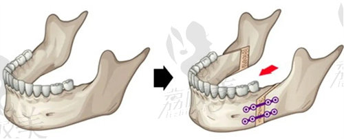 正颌手术示意图