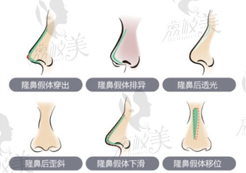 隆鼻失败情况示意图