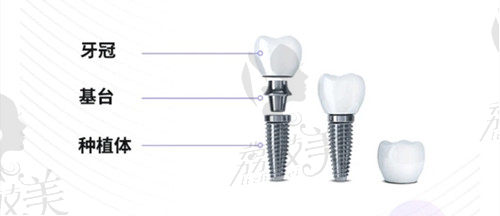 北京美莱口腔种植牙