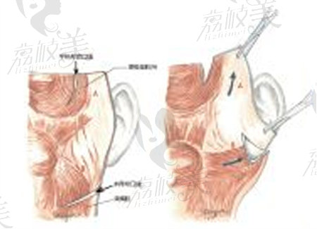 西安面部除皺醫(yī)生