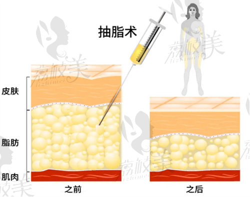 杭州时光整形吸脂价格多少？