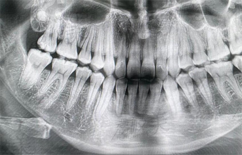 李运峰牙齿CT