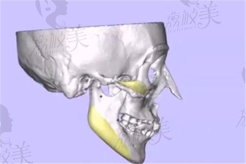 何晋龙做的3D颧弓颧骨术反馈不错