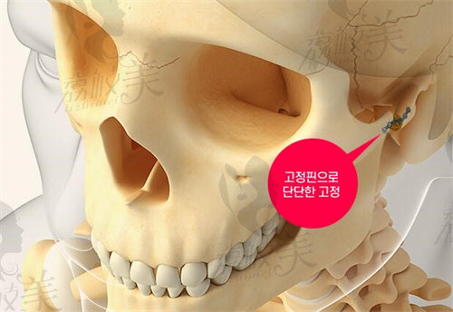 韩国1%(百分之一)整形外科颧骨固定 