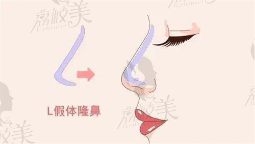 上海联合丽格的李鸿君的隆鼻技术不错