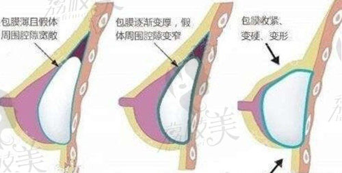 余力做胸比较保守吗