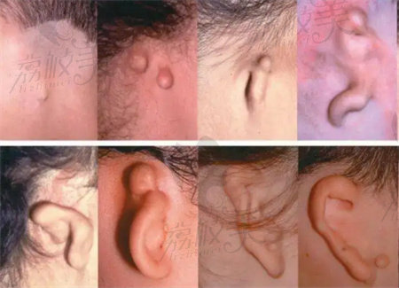 耳再造手术一般多少钱？