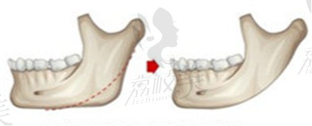 项昌峰磨骨怎么样？