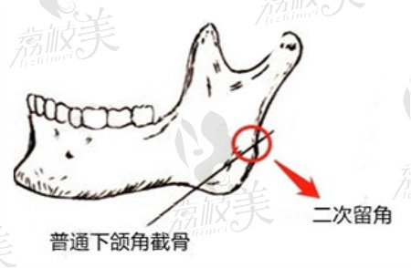 杭州磨骨医生哪个好？