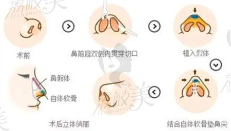 师俊莉做鼻子贵吗？