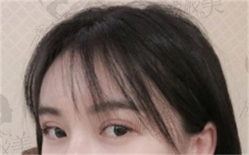 南京康美美容医院双眼皮修复示意图