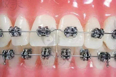 许沛霞医生在牙齿矫正方面的技术优势3