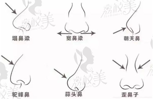 师俊莉鼻修复怎么样？