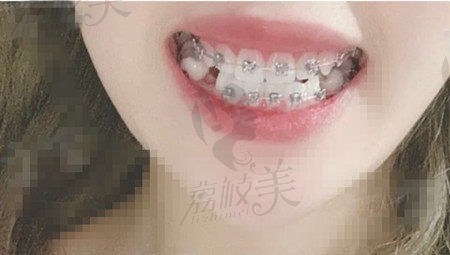 深圳美莱口腔正畸
