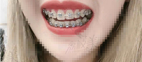 深圳美莱口腔正畸