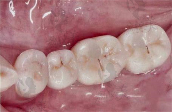 桂林源树口腔术后
