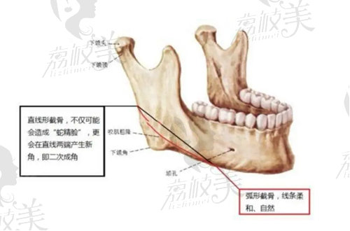 王勇医生做下颌角手术技术不错
