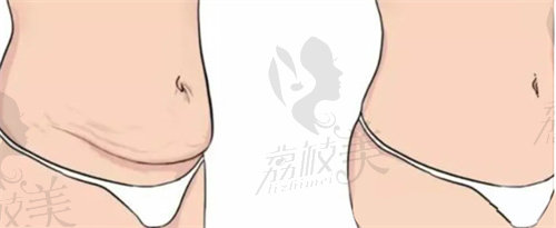 杭州做腹壁整形手术价格多少？