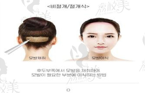韩国1%(百分之一)整形外科毛发移植缩小额头
