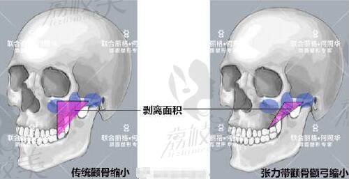 何照華張力帶固定和傳統(tǒng)固定區(qū)別