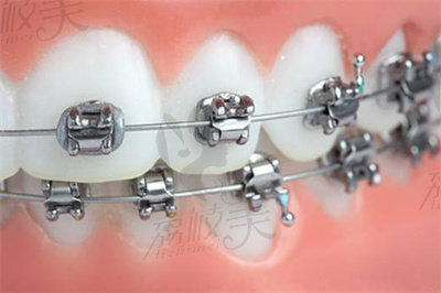 尚晓宇医生在牙齿矫正方面的技术优势1