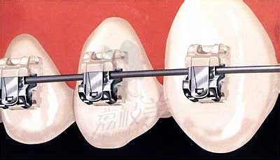 尚晓宇医生在牙齿矫正方面的技术优势3
