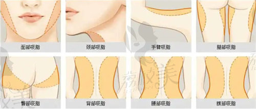 临安芘丽芙整形吸脂怎么样？