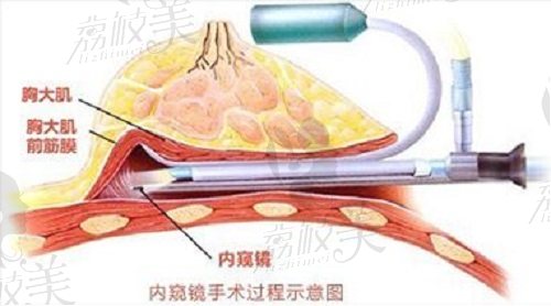 深圳曹孟君医生溢杯隆胸示意图