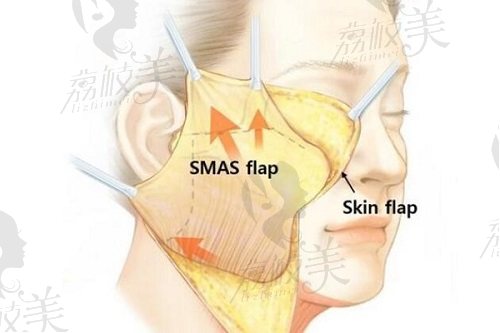 北京叶子整形美容医院smas除皱术